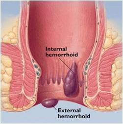 Hemorrhoids 